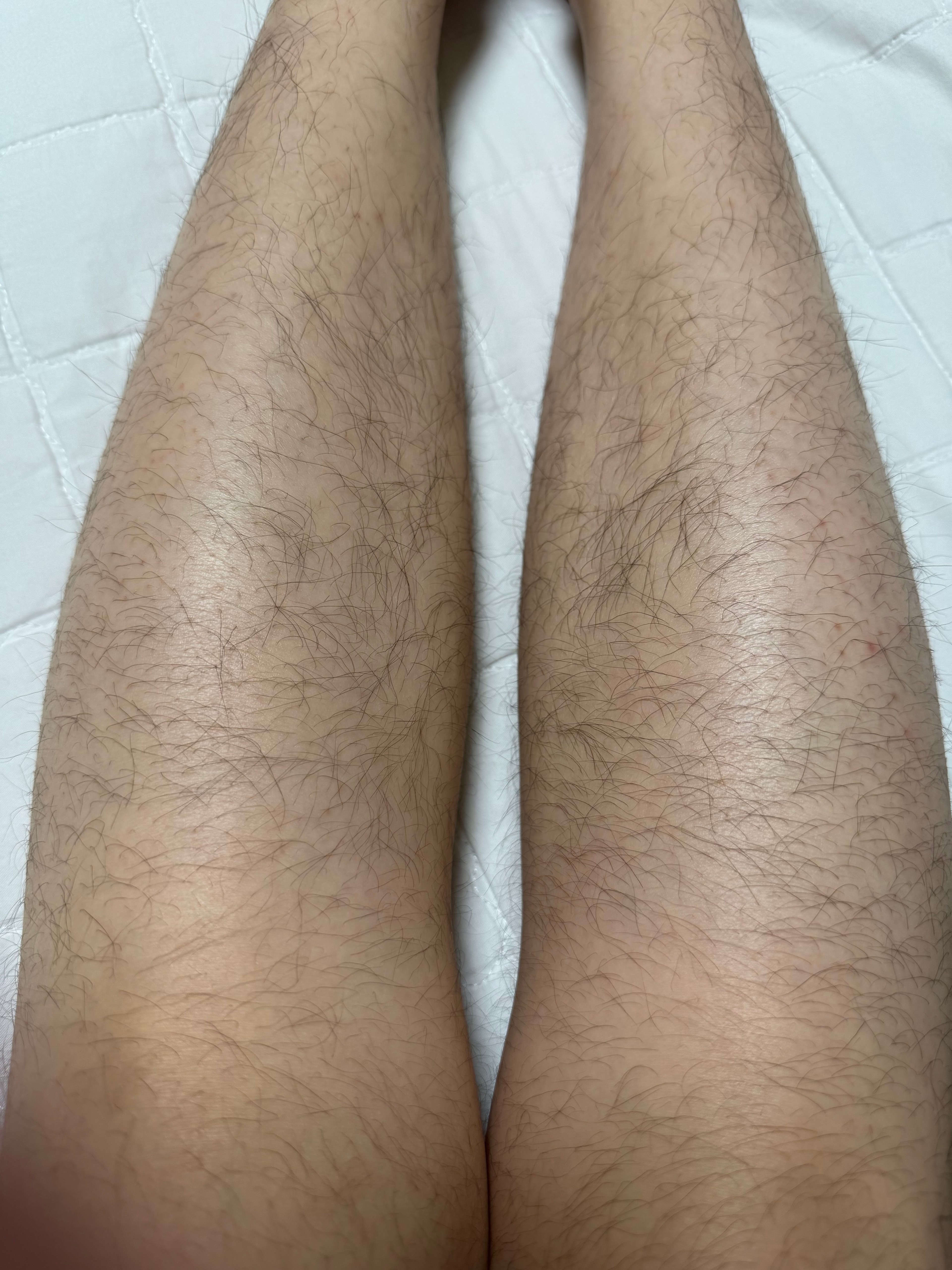 다리털이 너무 길고 까매서 병인지 아닌지 고민됨