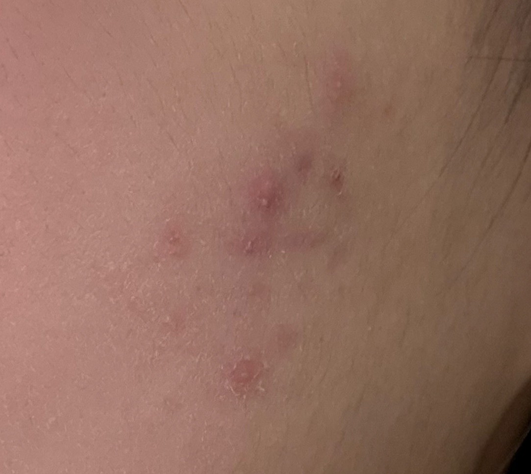 피부에 계속 머가나 사진주의!!