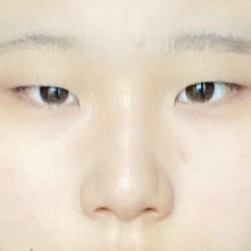 몽고주름 개심한데 앞트임 해야할까?(왼=하셈)