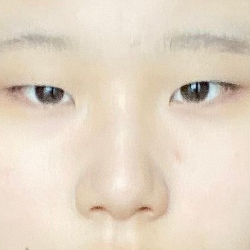 몽고주름 개심한데 앞트임 해야할까?(왼=하셈)