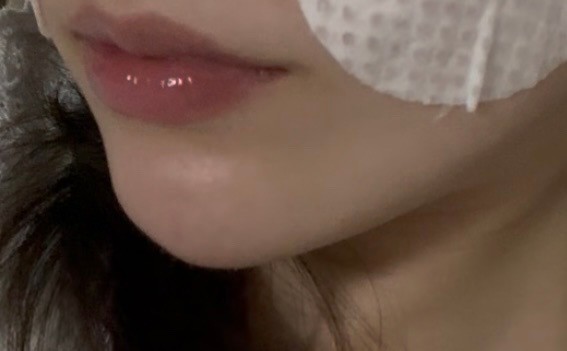 필러 다시맞아야될까(사진주의)