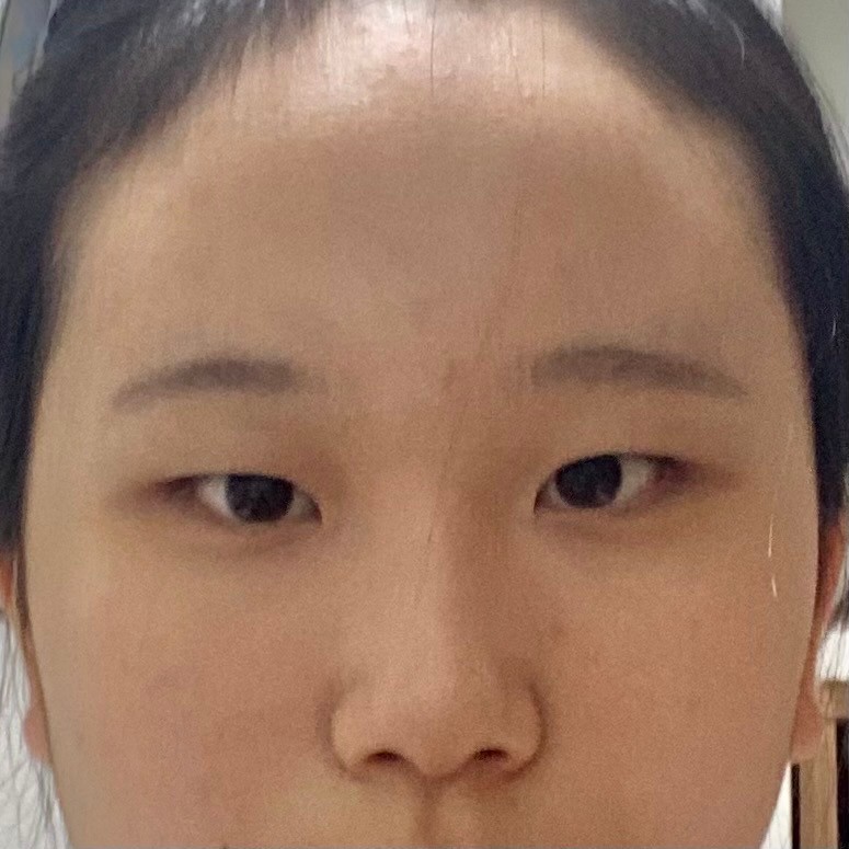 일주일째 고민중인데.. 앞트임 할까 말까?