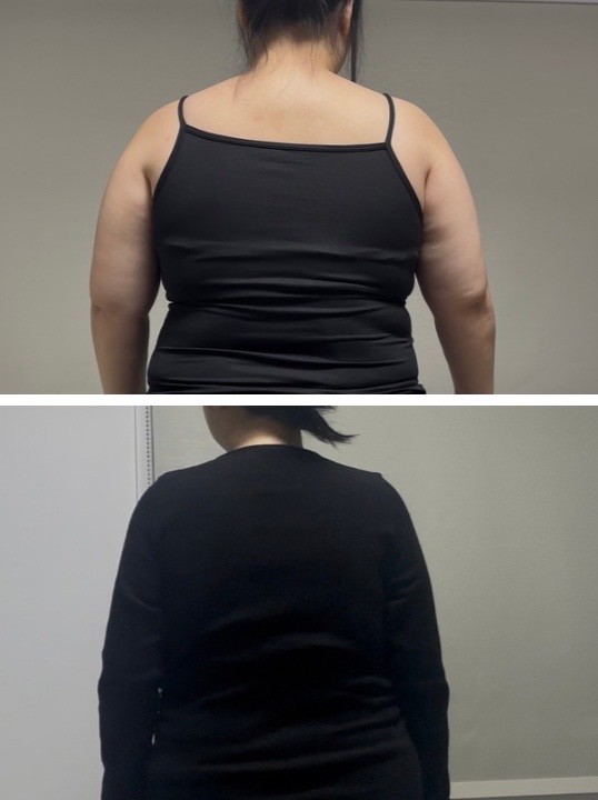 초고도비만 팔,등 지방흡입 한달차 솔직후기