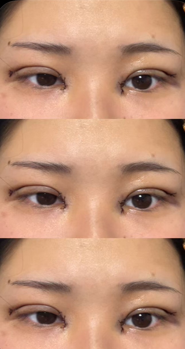 쌍수햇눈데 눈이 짝짝이야