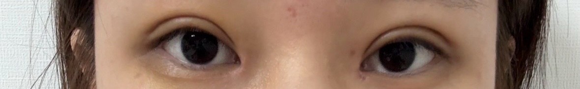 쌍수 라인 너무 낮은가..