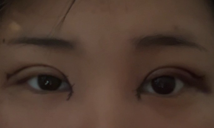 쌍수3일차인데 붓기 평가좀해주센