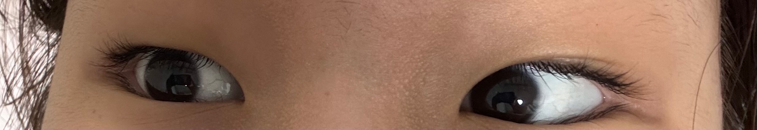 쌍수 망할 눈인가?